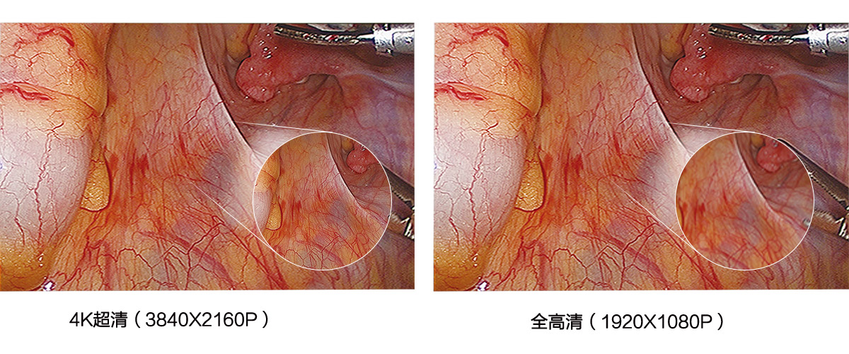 益柯達4K超高清內(nèi)窺鏡攝像系統(tǒng)