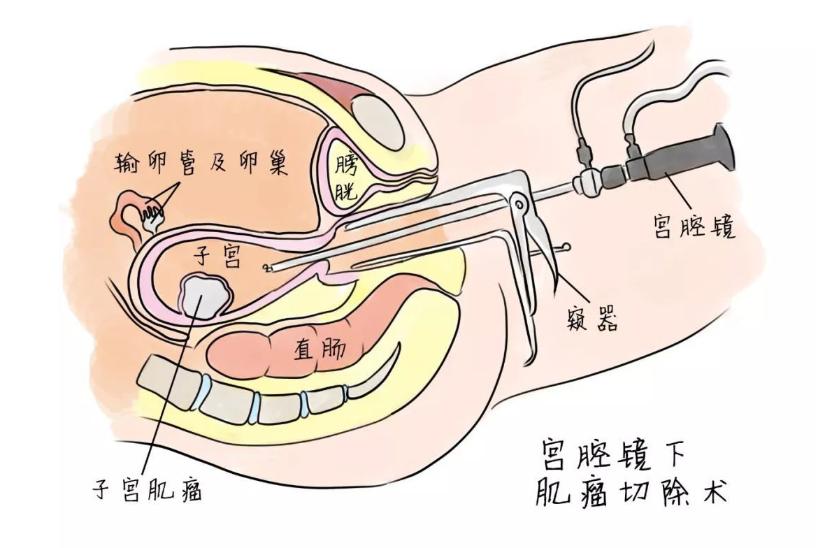 【宮腔鏡】宮腔鏡子宮肌瘤切除術(shù)